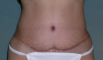 Tummy Tuck Before and After Photos