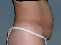 Tummy Tuck Before and After Photos