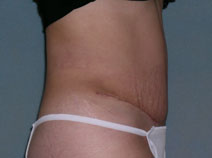 Tummy Tuck Before and After PhotosTummy Tuck Before and After Photos