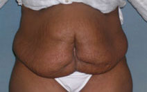 Tummy Tuck Before and After Photos