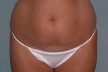 Tummy Tuck Before and After Photos