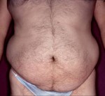 Tummy Tuck