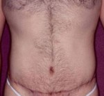 Tummy Tuck