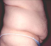 Tummy Tuck Before and After Photos