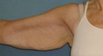 Arm Lift