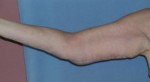 Arm Lift
