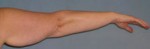 Arm Lift