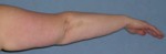 Arm Lift