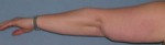 Arm Lift