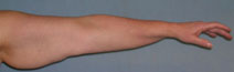 Arm Lift Before and After Photos | Dr. Balakhani