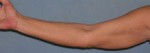 Arm Lift