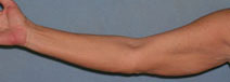 Arm Lift Before and After Photos | Dr. Balakhani