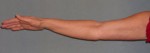Arm Lift