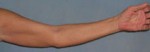 Arm Lift