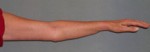 Arm Lift