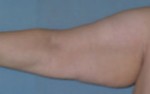 Arm Lift