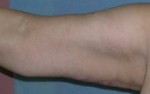 Arm Lift