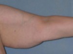 Arm Lift