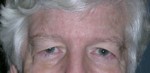 Blepharoplasty