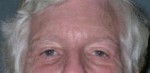 Blepharoplasty