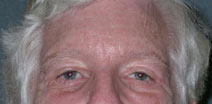 Blepharoplasty Before and After Photos