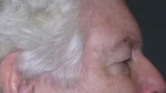 Blepharoplasty