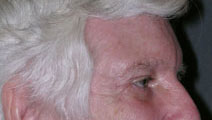 Blepharoplasty Case 2680 After Photo Blepharoplasty