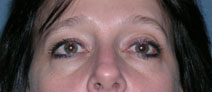 Blepharoplasty Case 2685 Before Photo Blepharoplasty