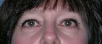 Blepharoplasty
