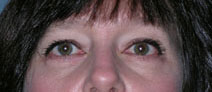 Blepharoplasty Before and After Photos