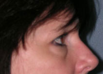Blepharoplasty Case 2685 Before Photo Blepharoplasty
