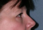Blepharoplasty