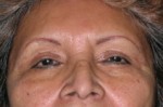 Blepharoplasty