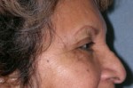 Blepharoplasty