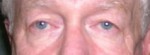 Blepharoplasty