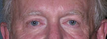 Blepharoplasty Case 2697 After Photo Blepharoplasty