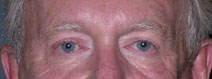 Blepharoplasty Before and After Photos