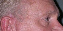 Blepharoplasty Before and After Photos