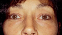 Blepharoplasty Before and After Photos