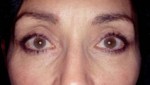 Blepharoplasty
