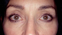 Blepharoplasty Before and After Photos