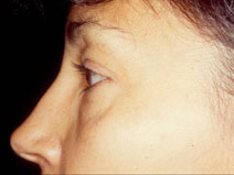 Blepharoplasty Before and After Photos