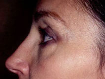 Blepharoplasty Before and After Photos