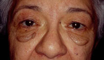 Blepharoplasty Before and After Photos