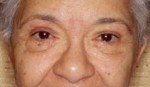 Blepharoplasty
