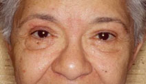 Blepharoplasty Before and After Photos