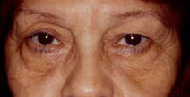 Blepharoplasty Before and After Photos