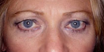 Blepharoplasty Before and After Photos