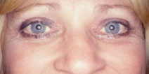 Blepharoplasty Before and After Photos