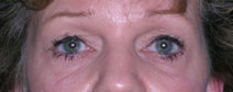 Blepharoplasty Before and After Photos